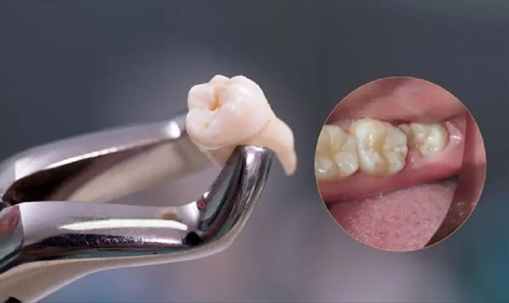 Những lợi ích của việc nhổ răng khôn tại nha khoa Sai Gon New Dental.