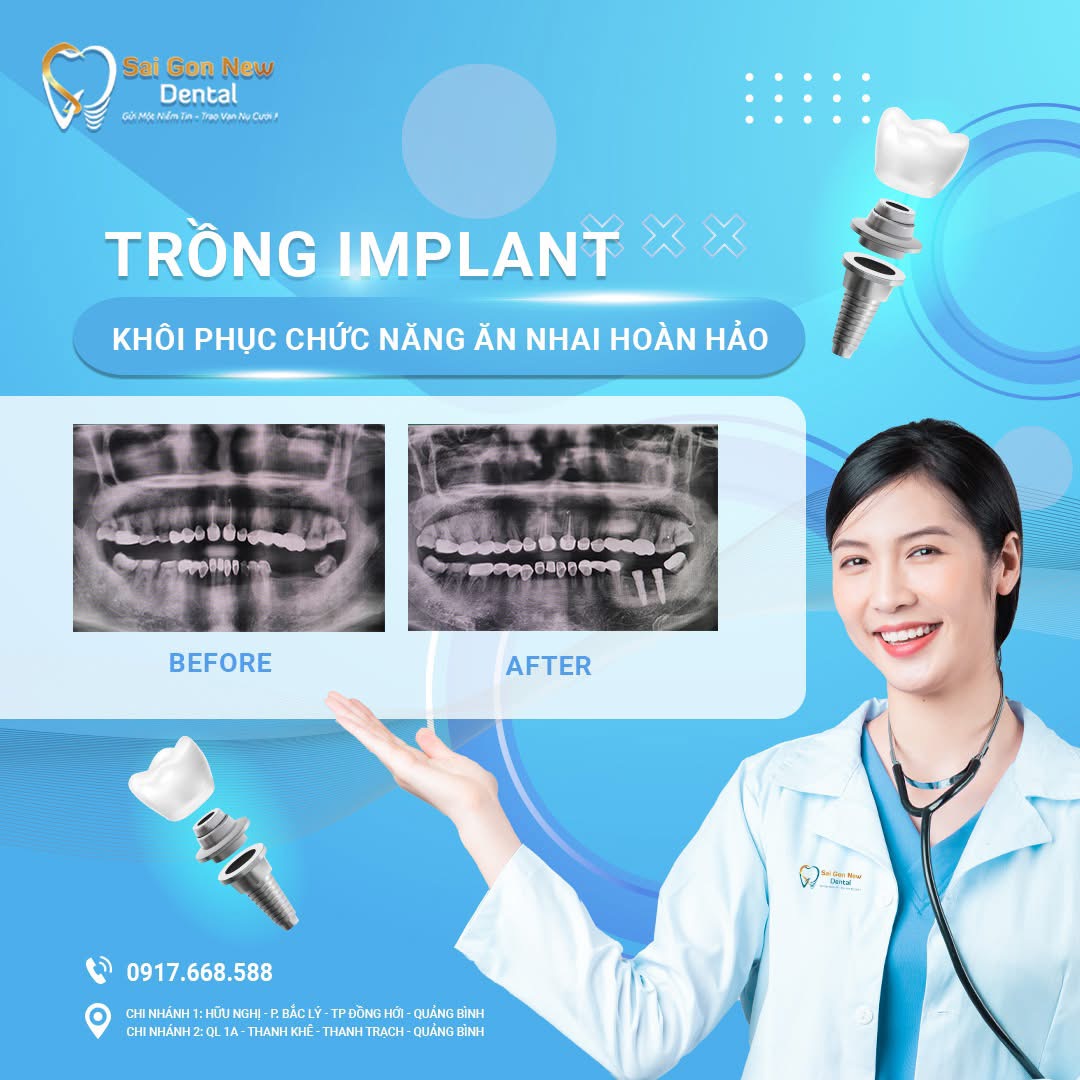 Quy trình trồng răng implant chất lượng tại nha khoa Sai Gon New Dental.