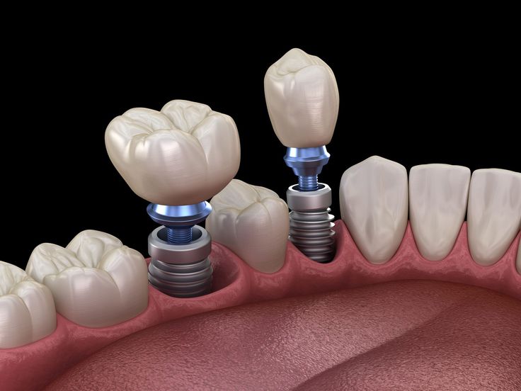 Quy trình cấy Implant và những lưu ý cần biết.