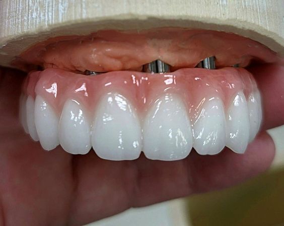 Trồng răng implant có tuổi thọ trung bình bao lâu?