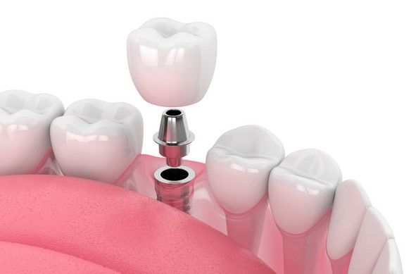 Những đối tượng khách hàng nào nên sử dụng dịch vụ trồng răng impant tại Sai Gon New Dental?