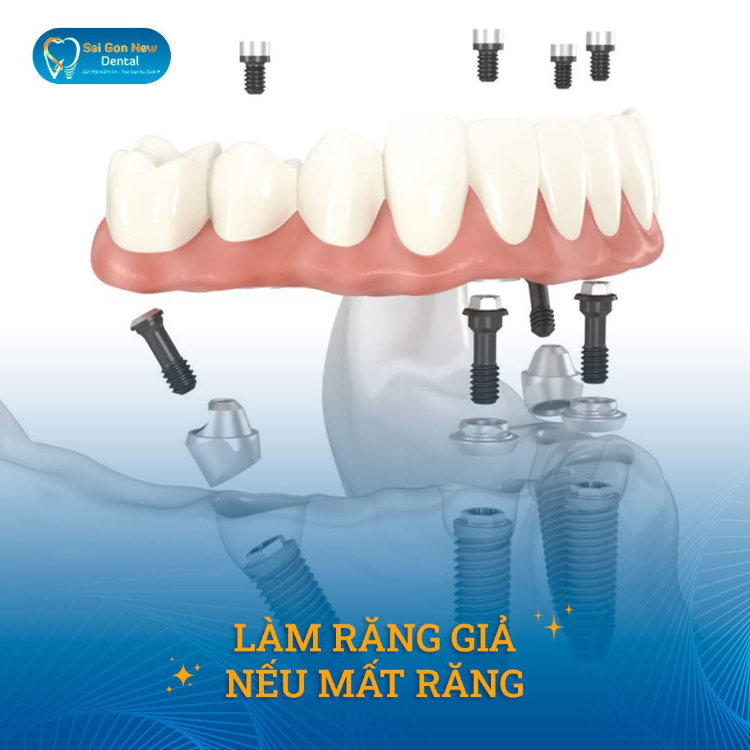 Quy trình trồng răng implant mất bao lâu?