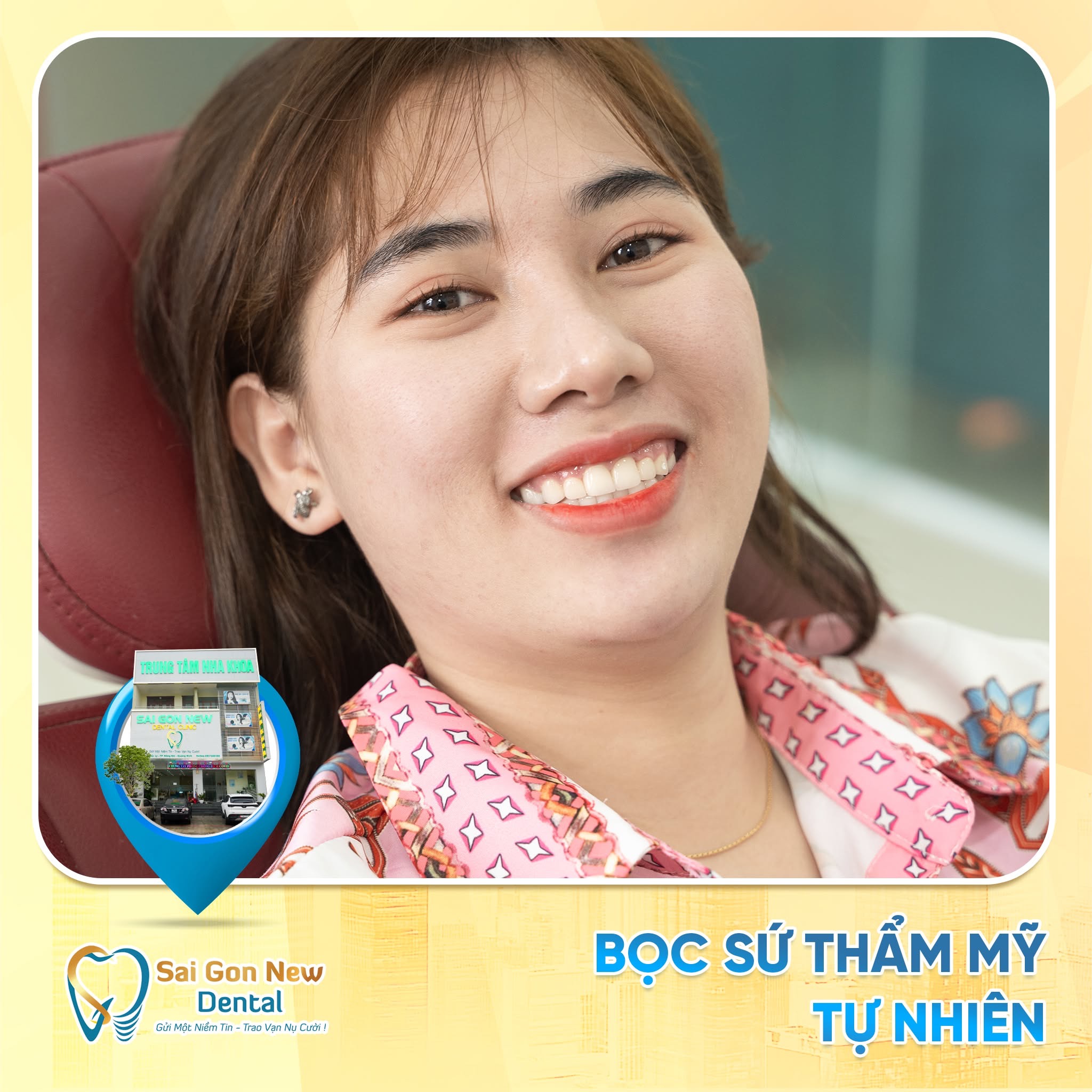 Bọc răng sứ thẩm mỹ.