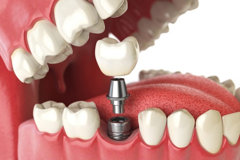 Những đối tượng khách hàng nên gắn implant?