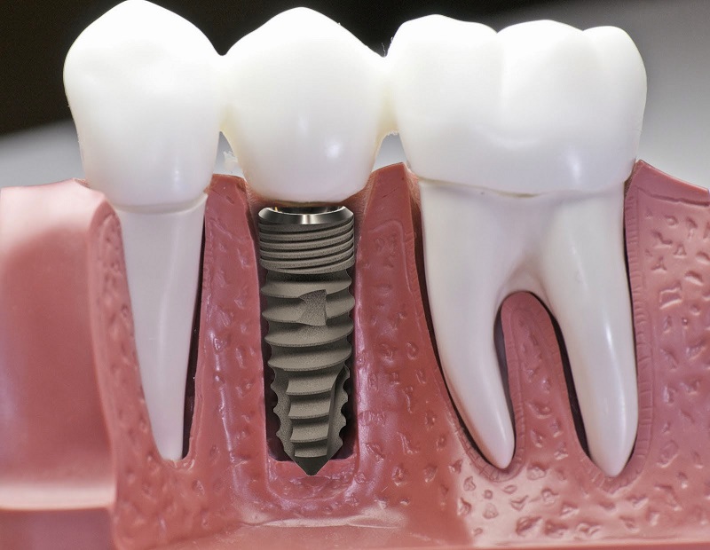 Bảng giá cấy ghép implant tại nha khoa Sai Gon New Dental.