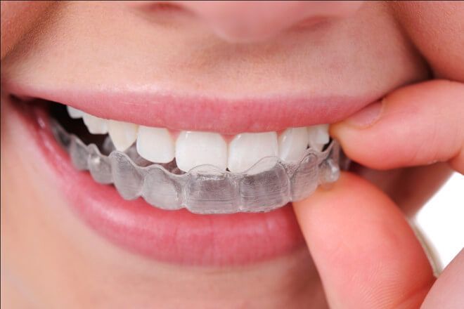 Niềng răng Invisalign là gì?