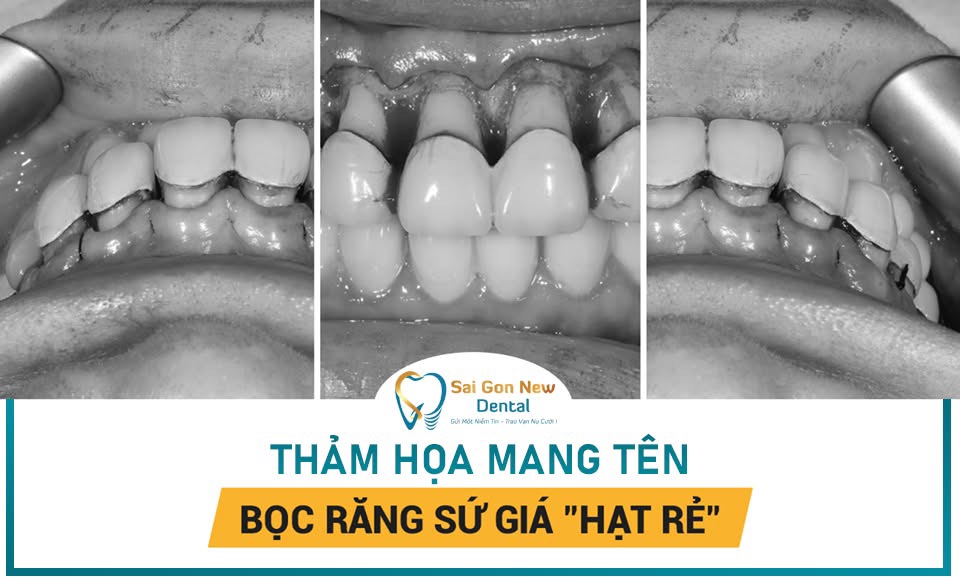 Vì sao nhiều người lựa chọn bọc răng sứ để cải thiện nụ cười?