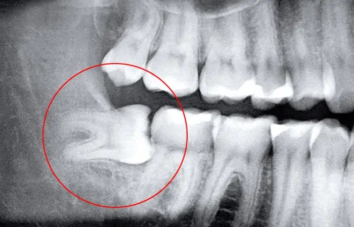 Giá nhổ răng khôn hàm dưới tại nha khoa Sai Gon New Dental giao động từ bao nhiêu?