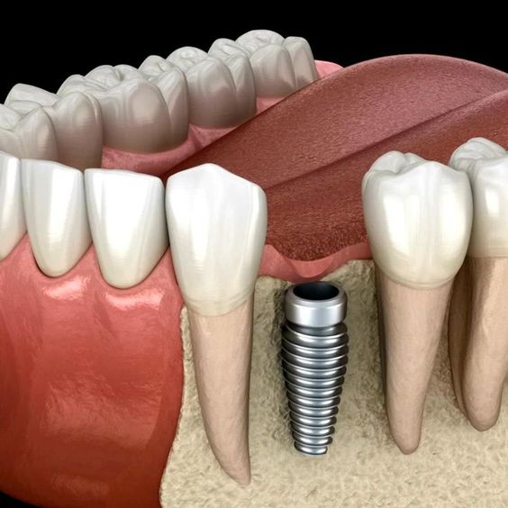 Ưu điểm vượt trội khi trồng răng implant.