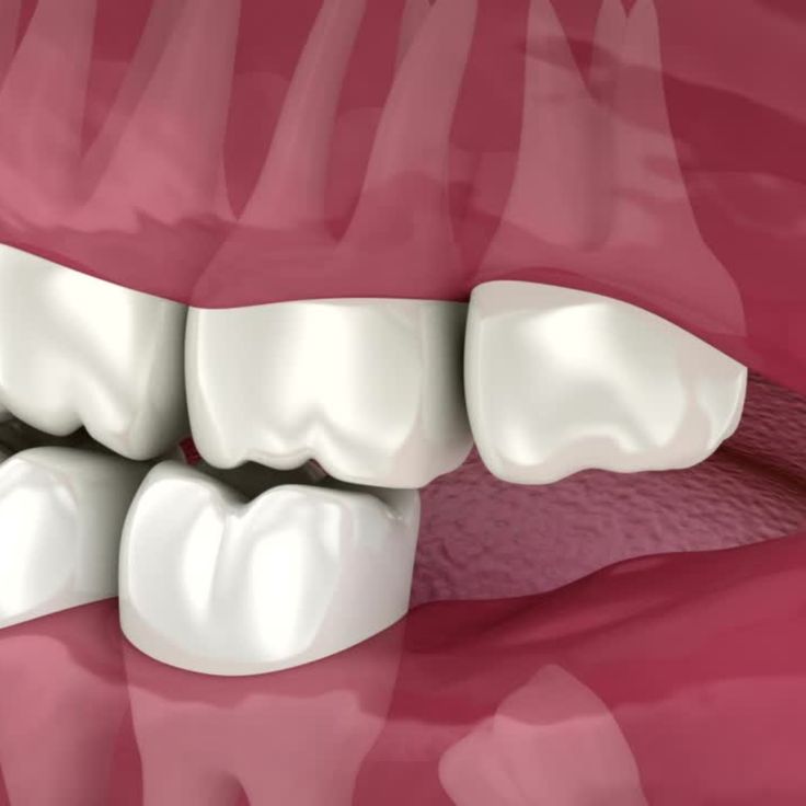 Bảng giá nhổ răng khôn tại nha khoa Sai Gon New Dental.