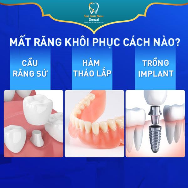 Bọc răng sứ thẩm mỹ có tuổi thọ bao lâu?