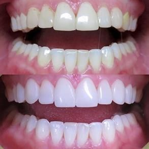 Vì sao khách hàng nên lựa chọn sử dụng dịch vụ bọc răng sứ tại Saigonnewdental?