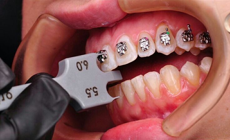 Dịch vụ niềng răng cho trẻ tại nha khoa Sai Gon New Dental.