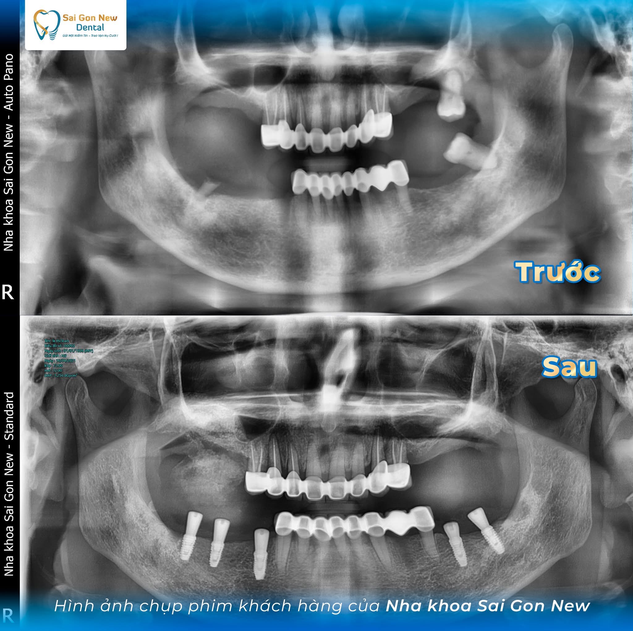 Làm thế nào để duy trì trồng răng implant bền vững trong nhiều năm?