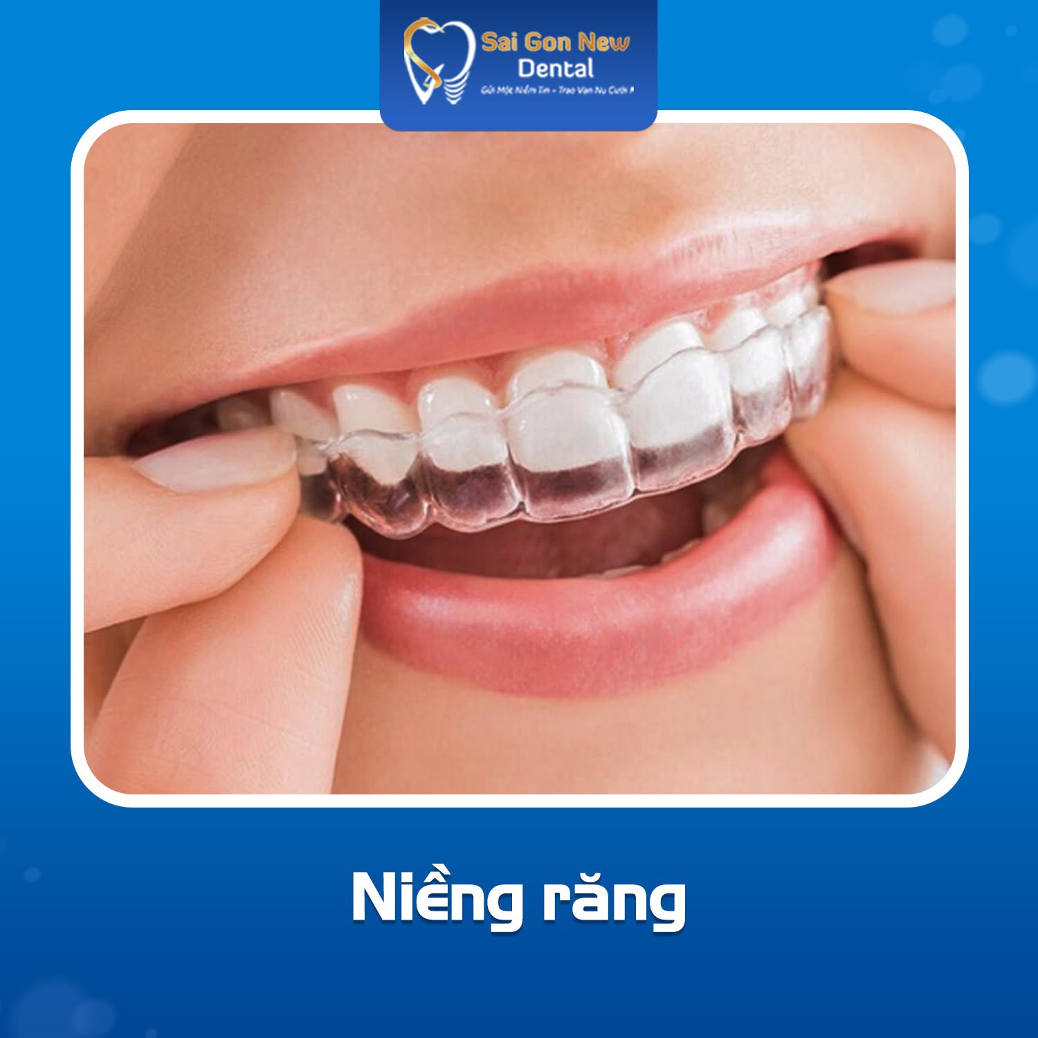 Niềng răng chỉnh nha.