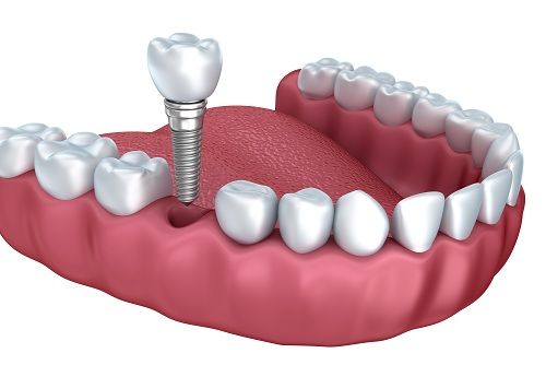 Vì sao dịch vụ trồng răng implant lại được thịnh hành và ưa chuộng nhiều hơn?