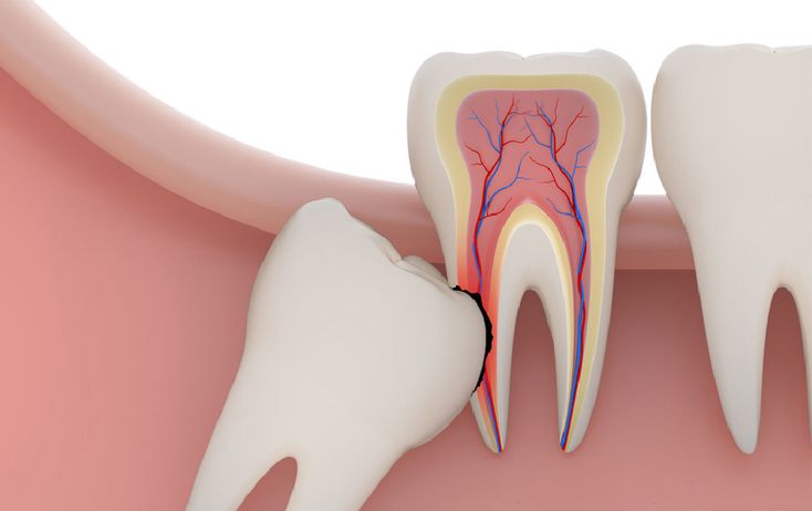 Những thực phẩm cần tránh trong thời gian nhổ răng khôn?