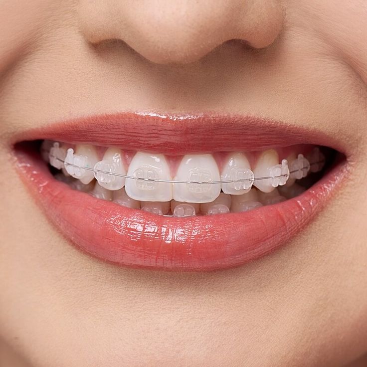 Bảng giá niềng răng mắc cài sứ tại nha khoa Sai Gon New Dental.