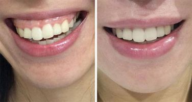 Bảng giá điều trị cười hở lợi tại Sai Gon New Dental.