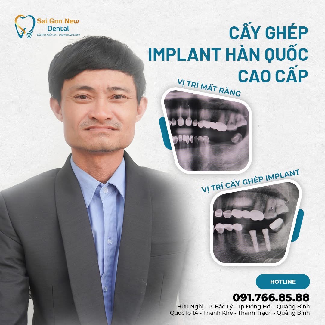 Bảng giá cấy ghép implant tại nha khoa Sai Gon New Dental.