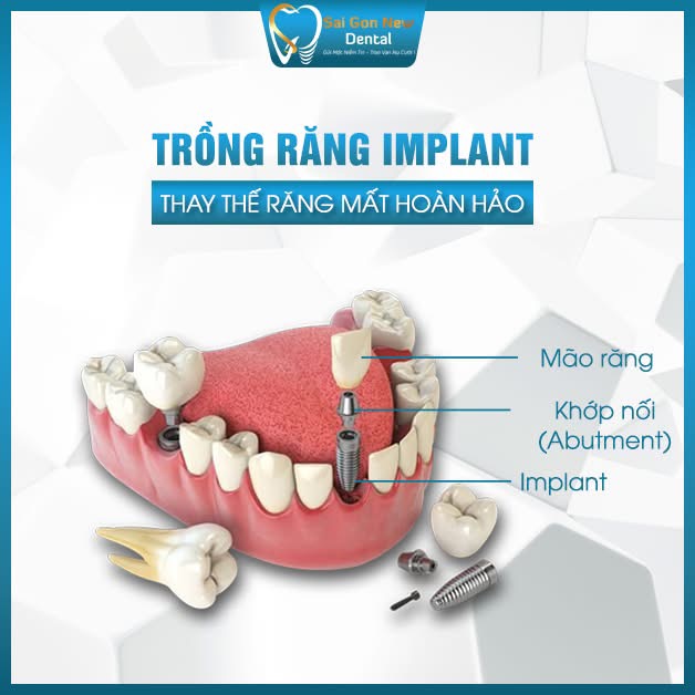 Dịch vụ trồng răng implant tại nha khoa Sai Gon New Dental.