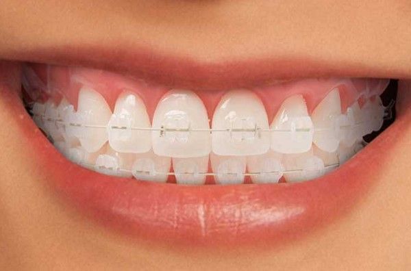 Niềng răng cho người hay di chuyển – tháo lắp dễ tại Đồng Hới có hiệu quả không?