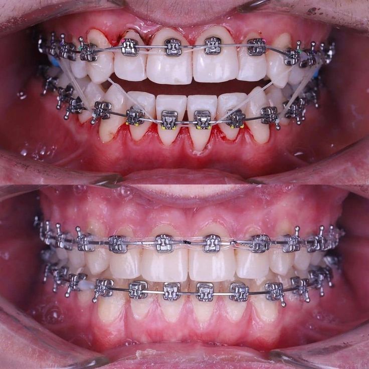 Lợi ích khi lựa chọn dịch vụ niềng răng cho trẻ 17 tuổi tại nha khoa Sai Gon New Dental.