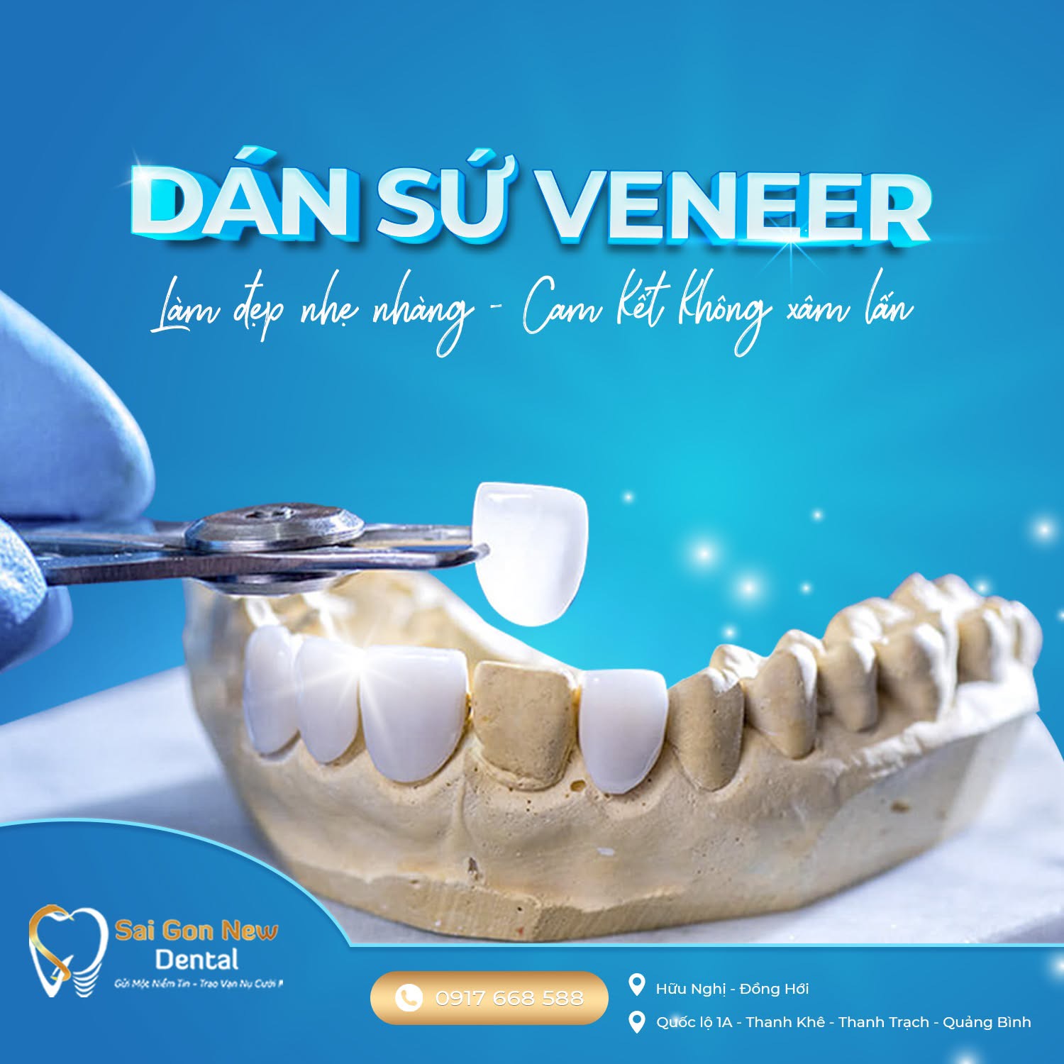 Dán sứ Veneer tại nha khoa Sai Gon New Dental.