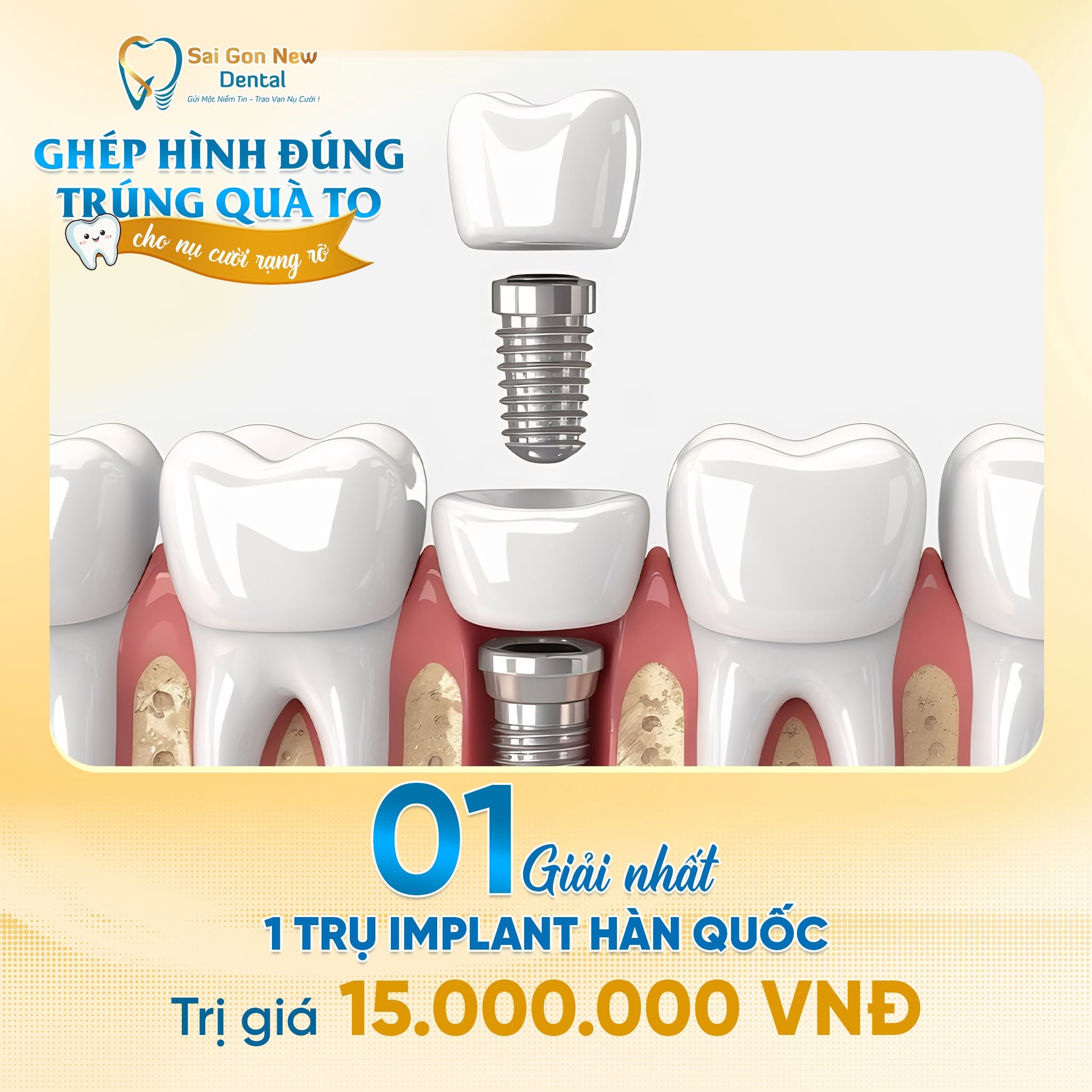 Trồng răng implant là gì?