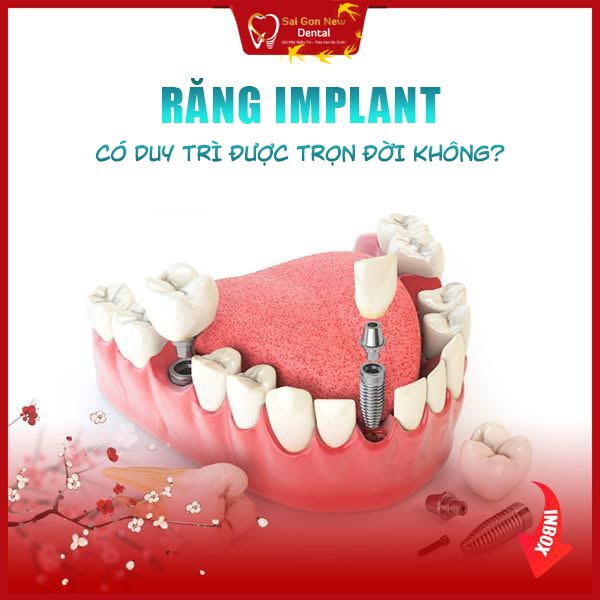 Giá trồng răng Implant tại nha khoa Sai Gon New Dental?