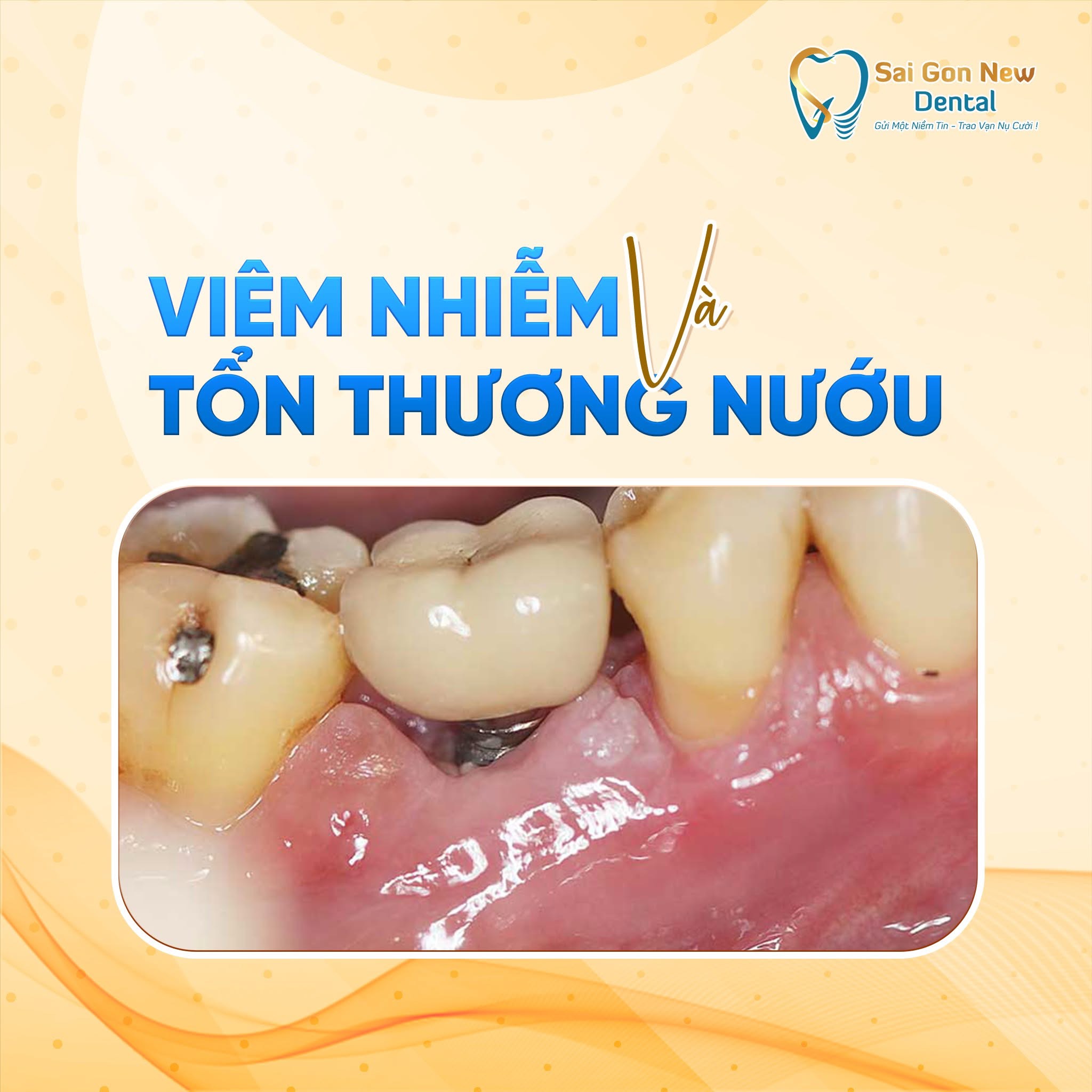 Những Ưu Điểm Của Trồng Răng Implant.