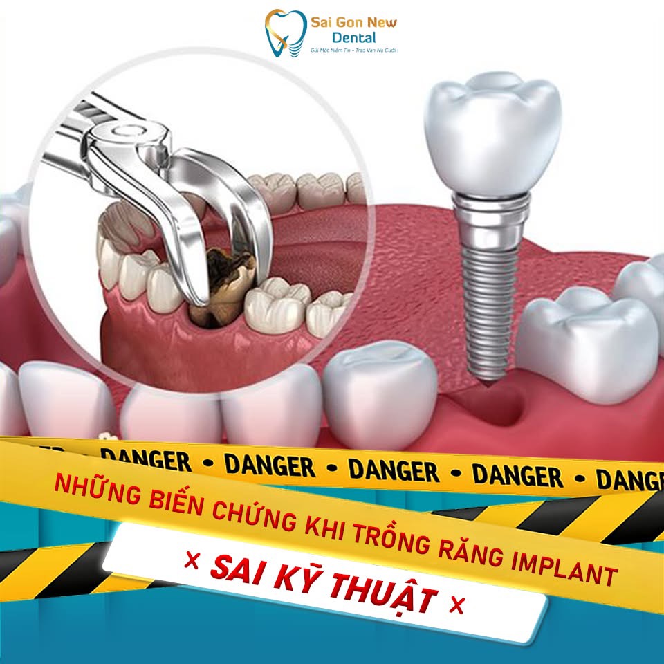 Kỹ thuật cấy ghép Implant Đồng Hới là gì?