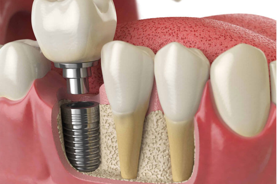 Những lý do khiến khách hàng nên sử dụng dịch vụ cấy ghép implant tiêu chuẩn.