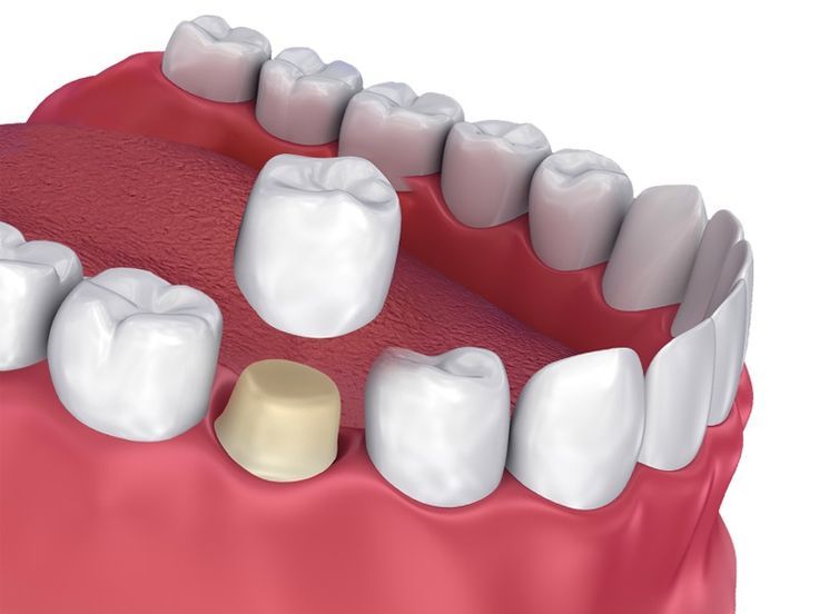 Bọc răng sứ thẩm mỹ uy tín tại nha khoa Sai Gon New Dental có gì đặc biệt?