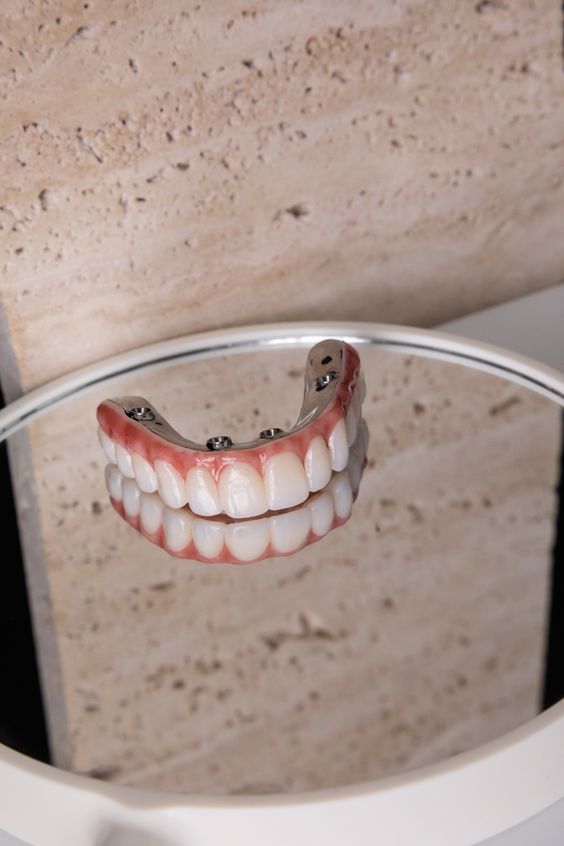 Trồng răng implant có giá như thế nào?