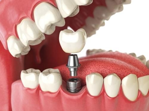 Trồng răng implant phổ biến nhất hiện nay.