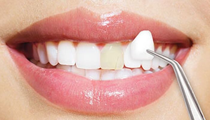 Dịch vụ bọc răng sứ thẩm mỹ tại Sai Gon New Dental.