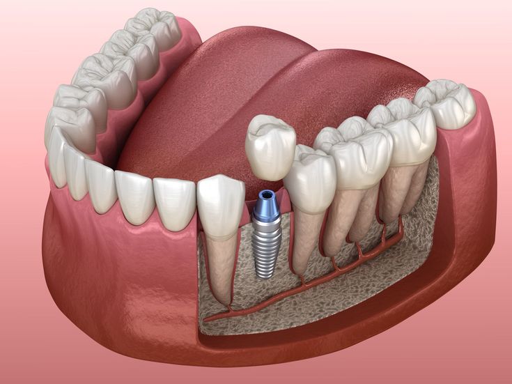 Khi nào nên cấy Implant?