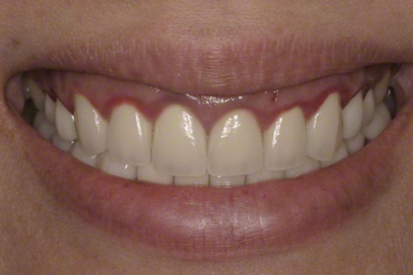 Viêm nướu do bọc răng sứ thường có biểu hiện viền nướu đỏ và dễ chảy máu