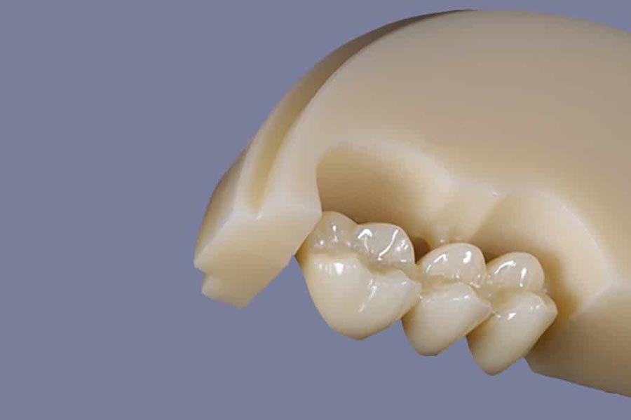 Răng sứ zirconia nguyên khối