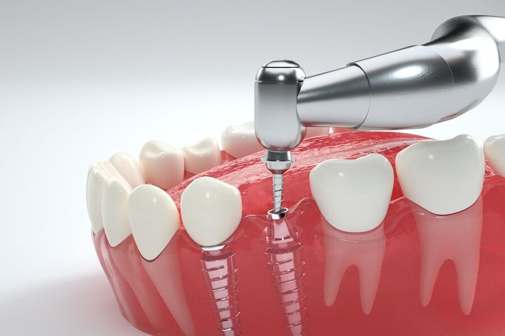 Trồng răng implant là gì?