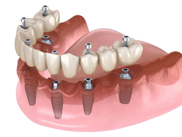 Những Ưu Điểm Của Trồng Răng Implant.