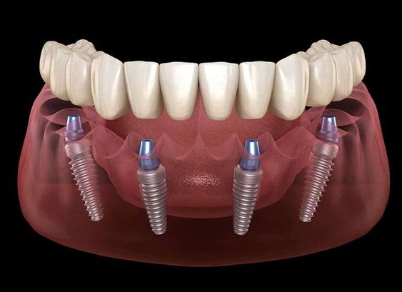 Trồng răng implant có tác dụng gì?