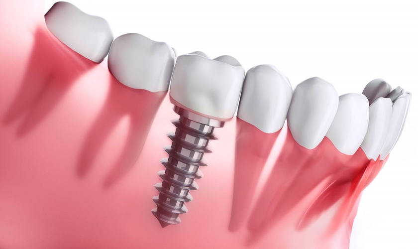 Dịch vụ kỹ thuật cấy ghép Implant Đồng Hới.