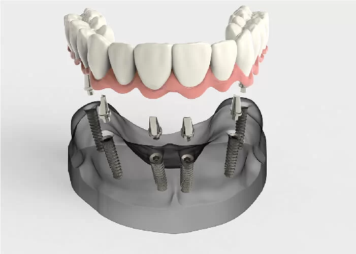 Lợi ích khi sử dụng dịch vụ cấy ghép răng trụ implant tại nha khoa Sai Gon New Dental.