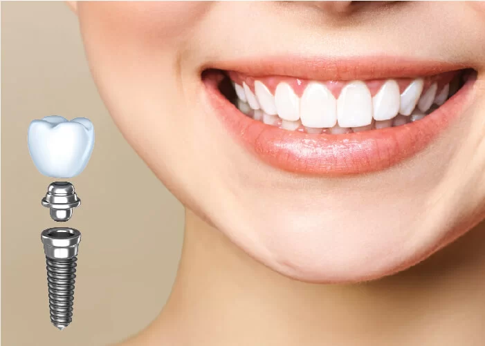 Ưu điểm của cấy ghép implant là gì?