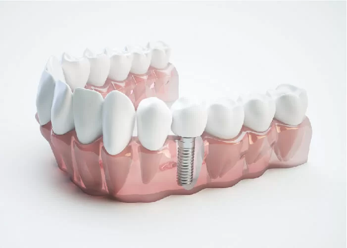 Liệu có nên sử dụng dịch vụ cấy ghép răng trụ implant?