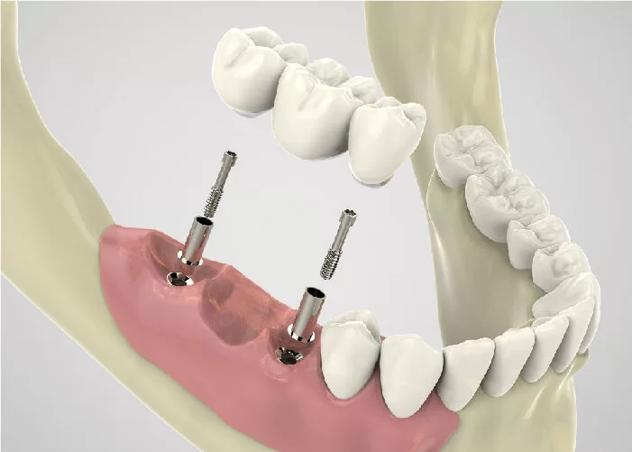 Bảng giá dịch vụ cấy ghép răng trụ implant tại nha khoa Sai Gon New Dental.