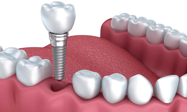 Quy trình cấy ghép implant uy tín tại nha khoa Sai Gon New Dental.