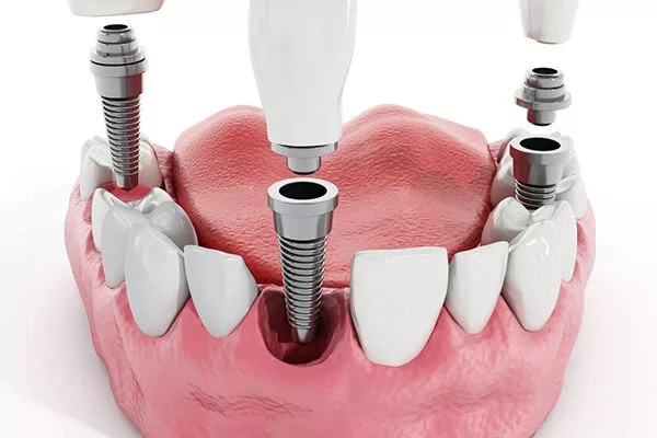 Những lưu ý khi sử dụng dịch vụ kỹ thuật cấy ghép implant.